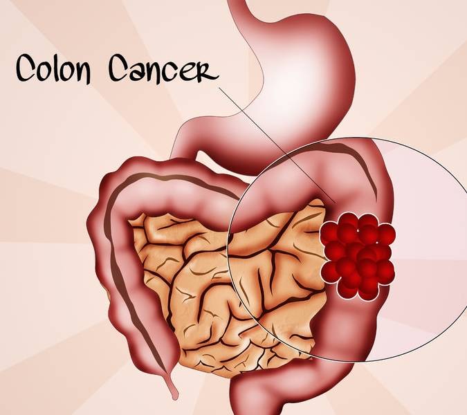 80％直肠癌最初被当痔疮，医生警告