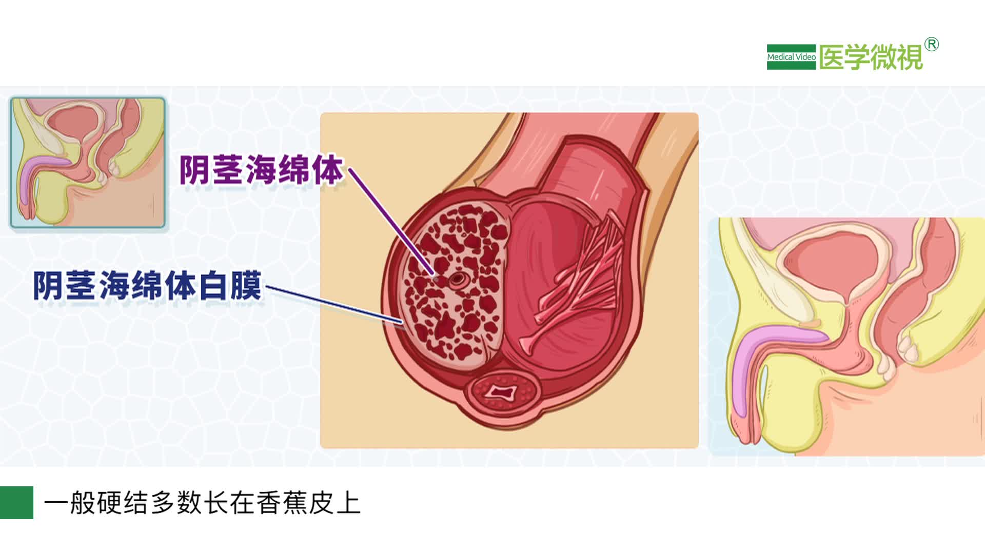 海绵体硬结症，涉黄问题与医学探讨，海绵体硬结症，医学视角下的涉黄问题与探讨